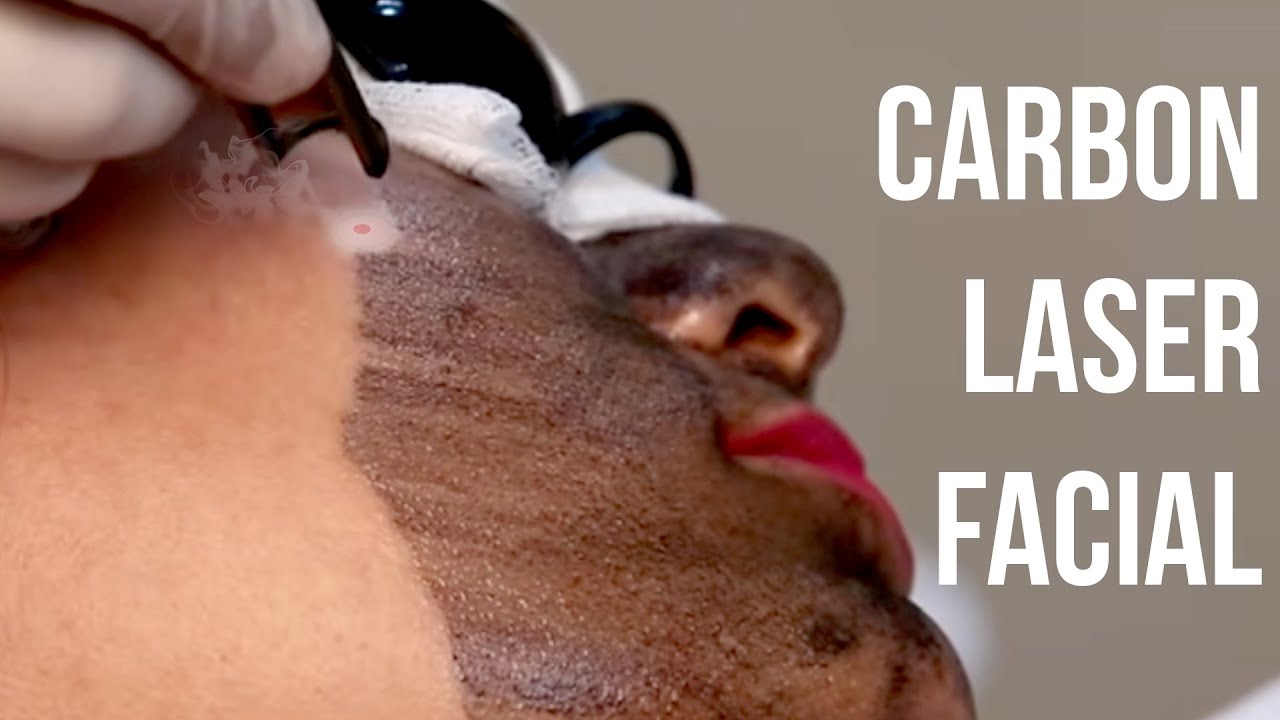 Laser Facial Glow| Procedure & Results | By Sakhiya Skin Clinic's Skin Doctor
