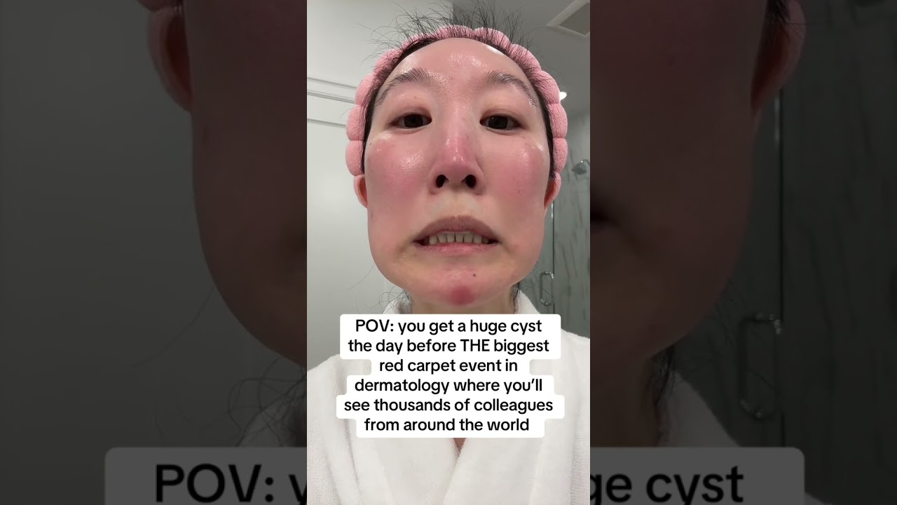 How to Shrink a Cystic Pimple FAST! Dermatologist&rsquo;s Emergency Fix 🚨
