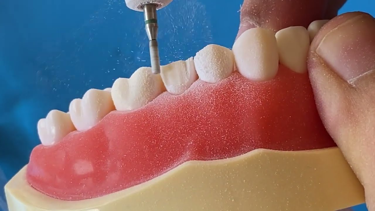 Maxillary Premolar Crown Preparation | Maksiller Premolar Diş Preparasyon  (Kesim)