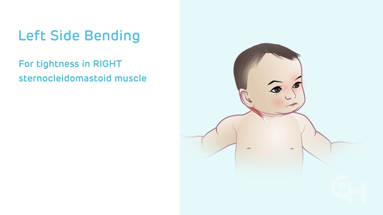Congenital Muscular Torticollis: Stretching
