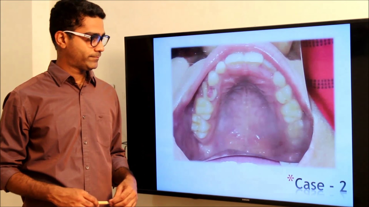 Хранитель пространства для начинающих