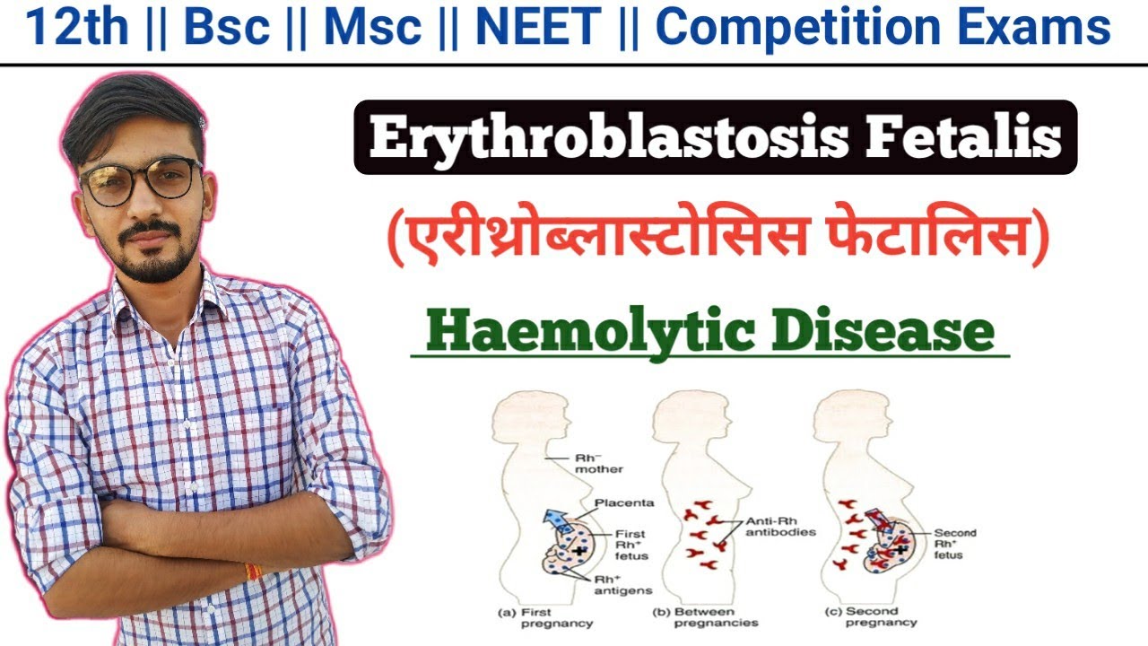 Erythroblastosis Fetalis In Hindi || Haemolytic Disease || By Dadhich Sir