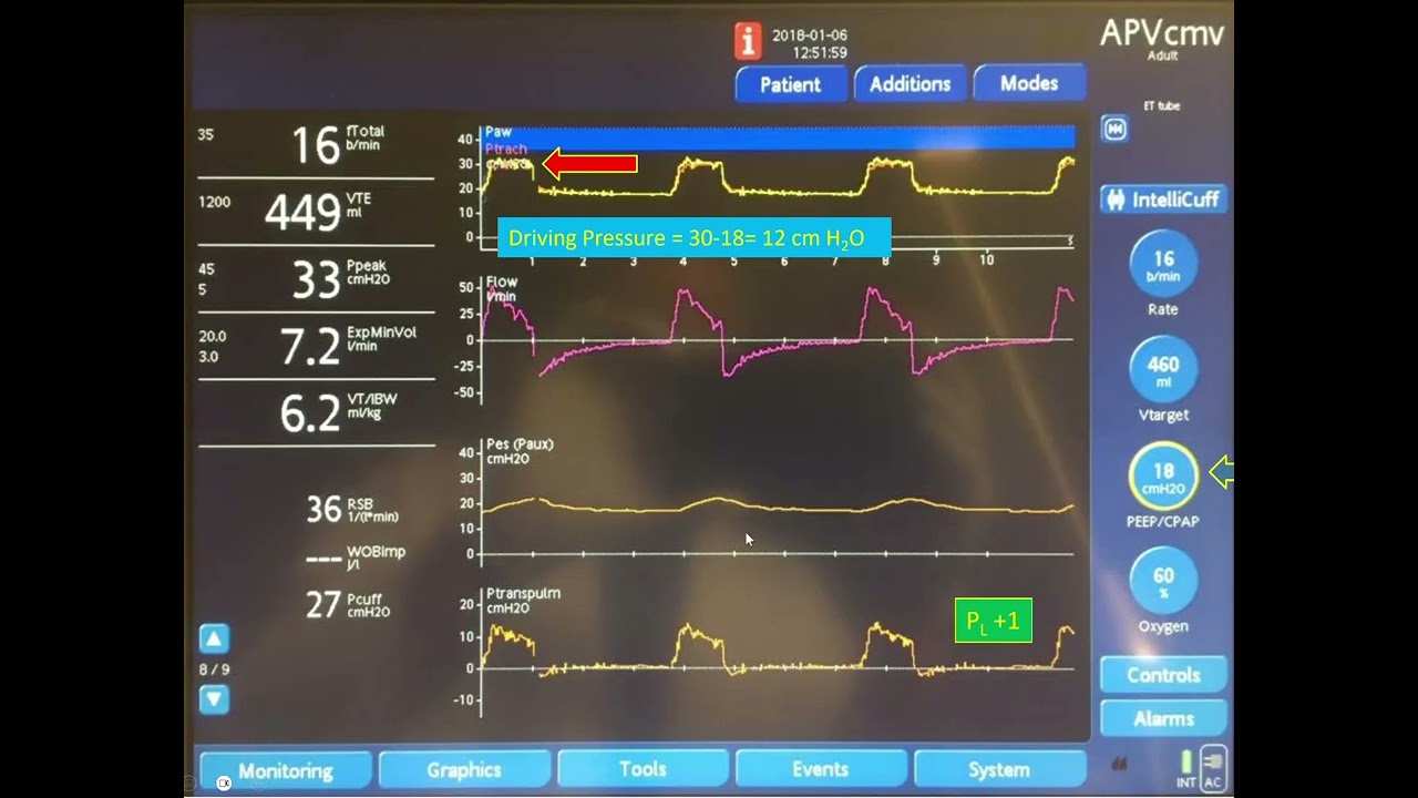 Esophageal Pressure Monitoring and Use of Transpulmonary Pressure to Determine the Best PEEP in ARDS