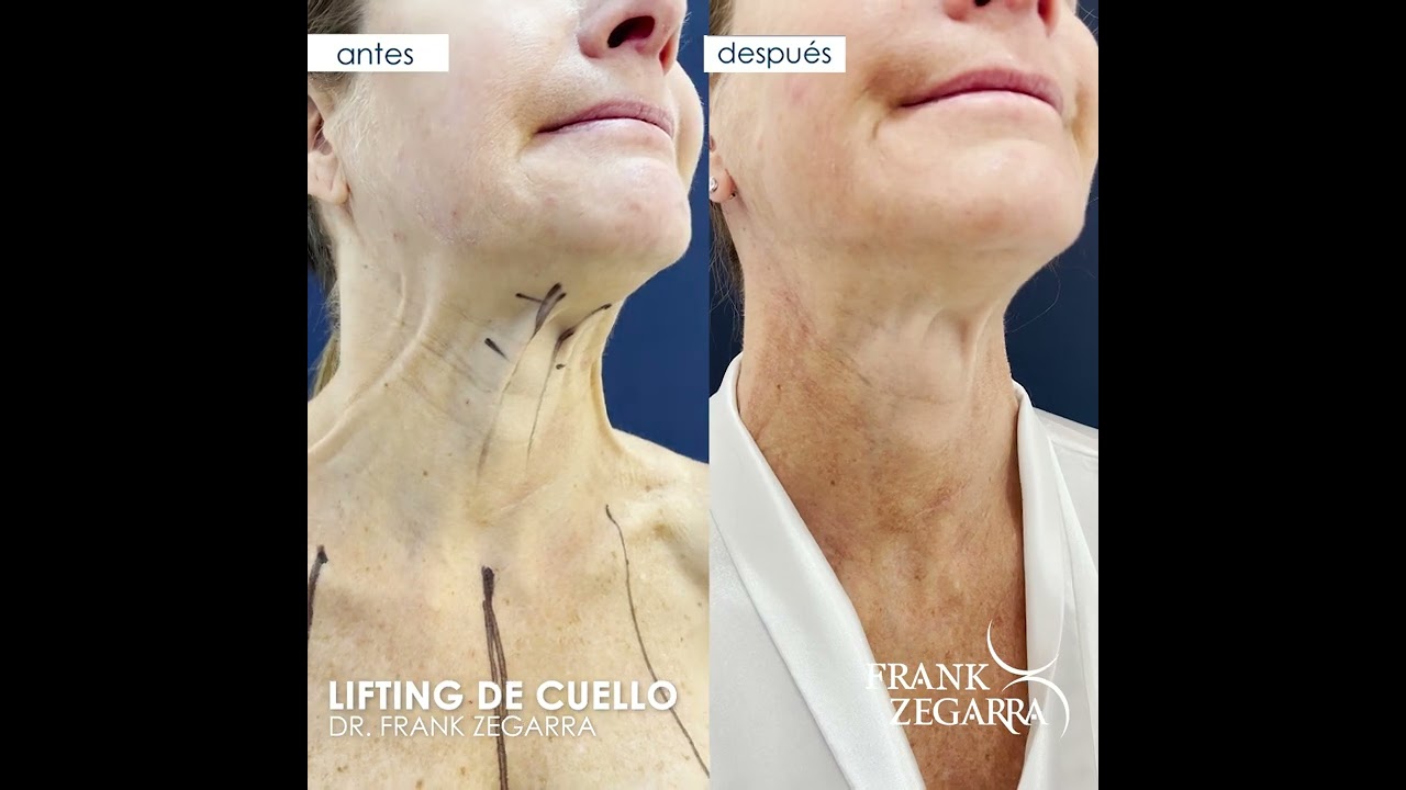 LIFTING DE CUELLO