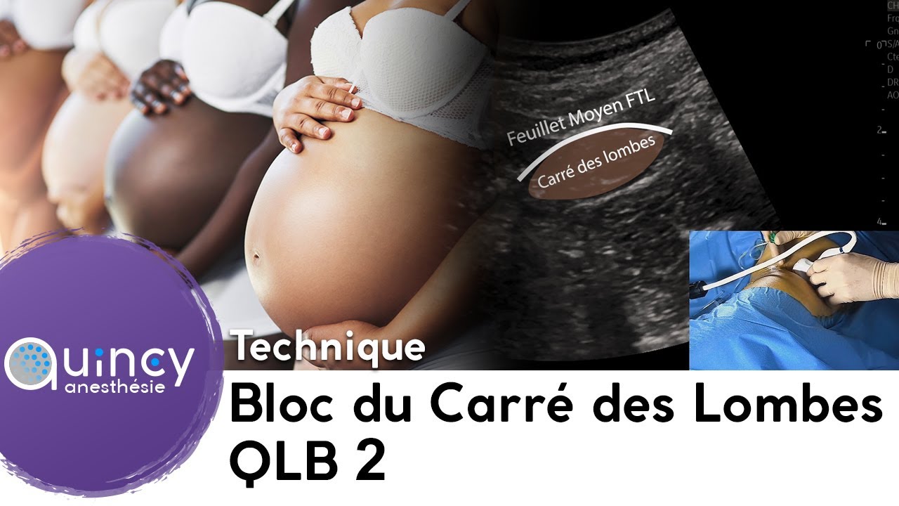 Bloc du Carré de Lombes, Quadratus Lumborum Block de type 2 (QLB 2)