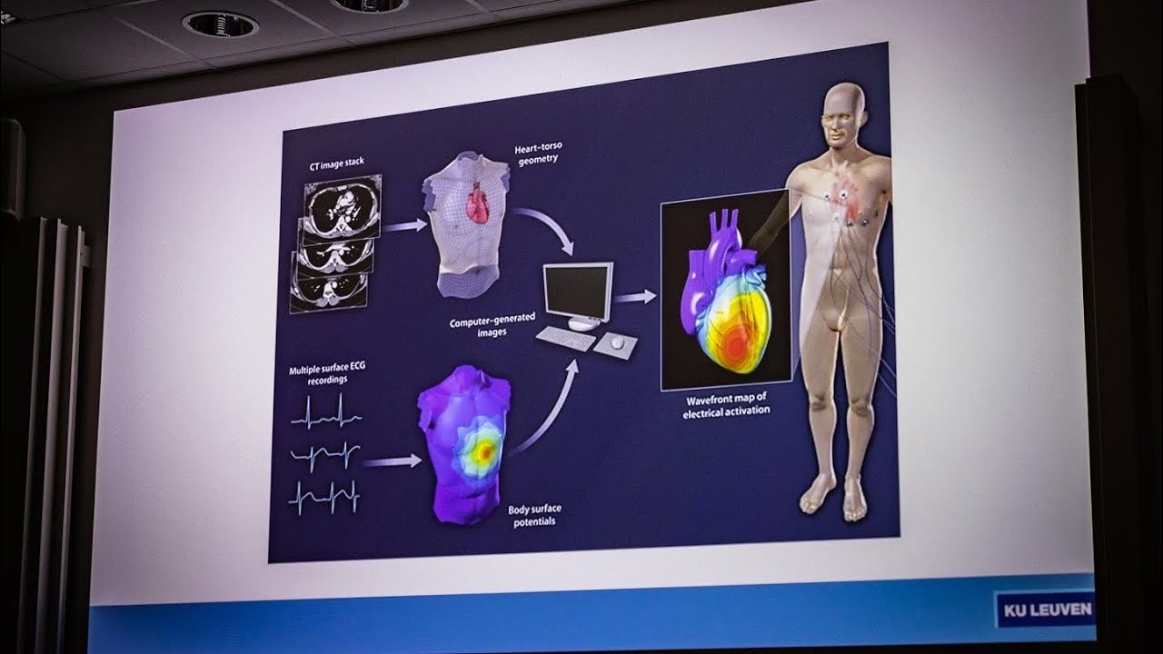 Plotse cardiale dood bij ischemisch hartlijden - De ICD