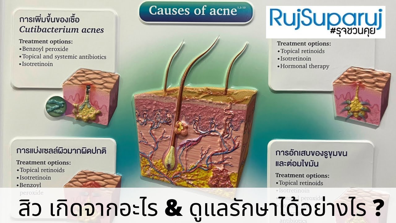 สิว เกิดจากอะไร & ดูแลรักษาได้อย่างไร ? 