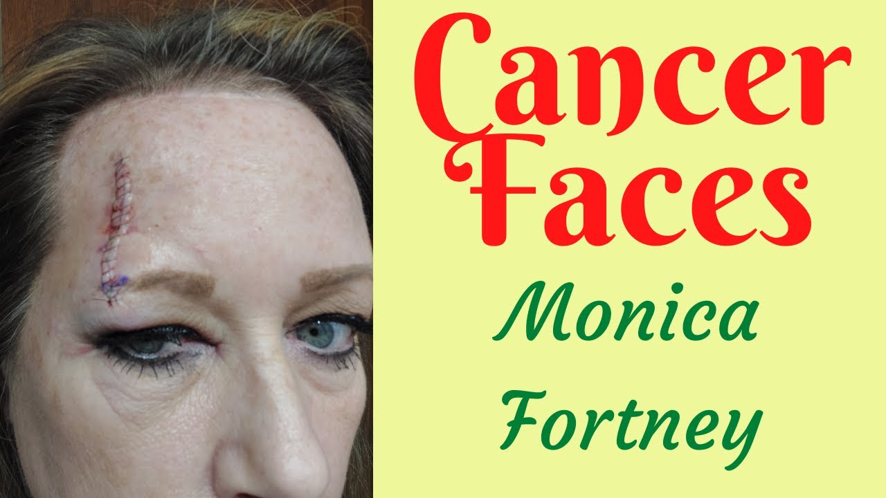 Cancer Faces: Monica Fortney's Journey