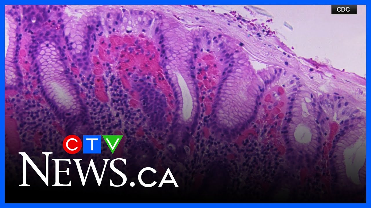 Manitoba student works on cholera treatment