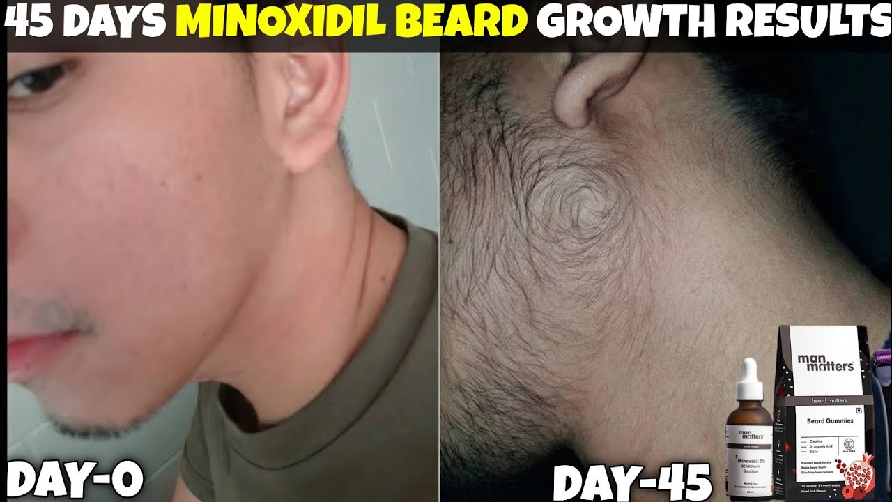 45 days man matters beard growth results | man matters beard growth kit review | minoxidil beard|