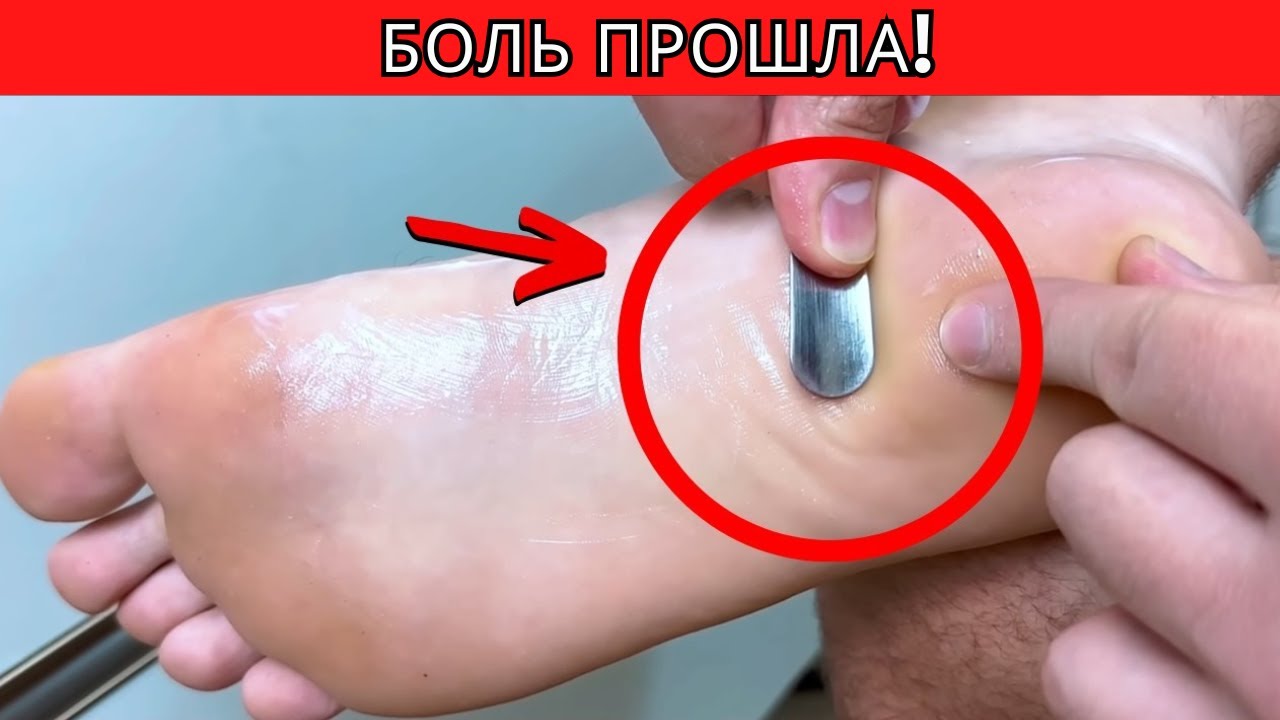 Подошвенный фасциит: домашнее лечение, которое действительно работает