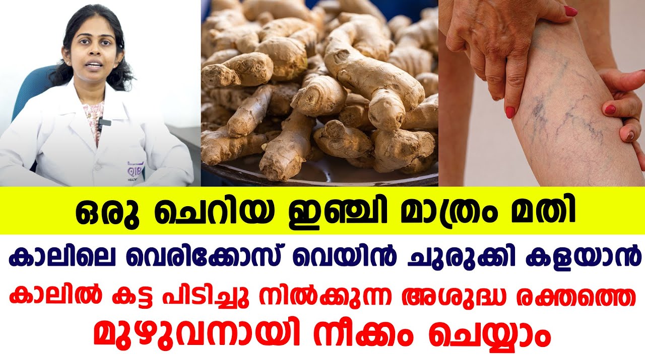 ഒരു ചെറിയ ഇഞ്ചി മാത്രം അതി കാലിലെ വെരിക്കോസ് വെയിൻ ചുരുക്കി കളയാൻ | Varicose veins Malayalam