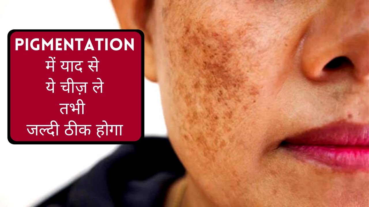 Pigmentation में याद से ये चीज़ ले तभी जल्दी ठीक होगा I Most Important Food in Pigmentation