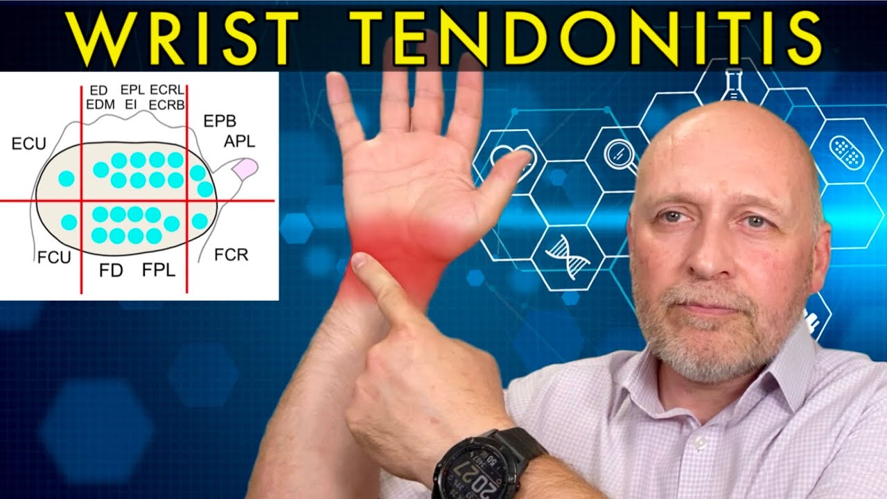 Is your Wrist Pain a Tendonitis? All about Diagnosis, Treatment and Recovery
