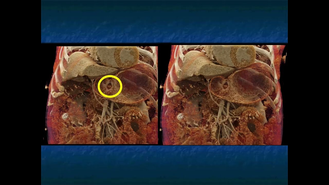 CT Evaluation of GI Bleeding - Part 1