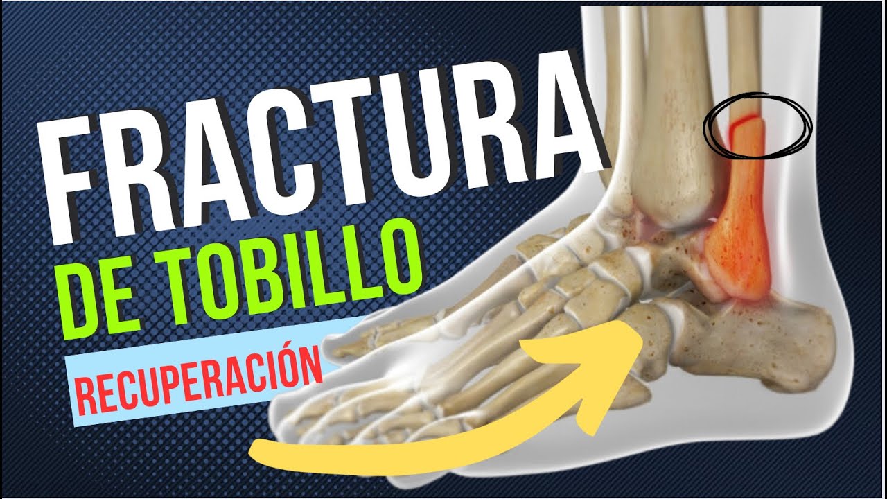 4 ejercicios recupérate FRACTURA DE TOBILLO