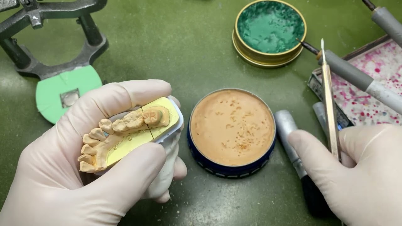 【歯科技工】ワックスアップ〜マージン締めまで
