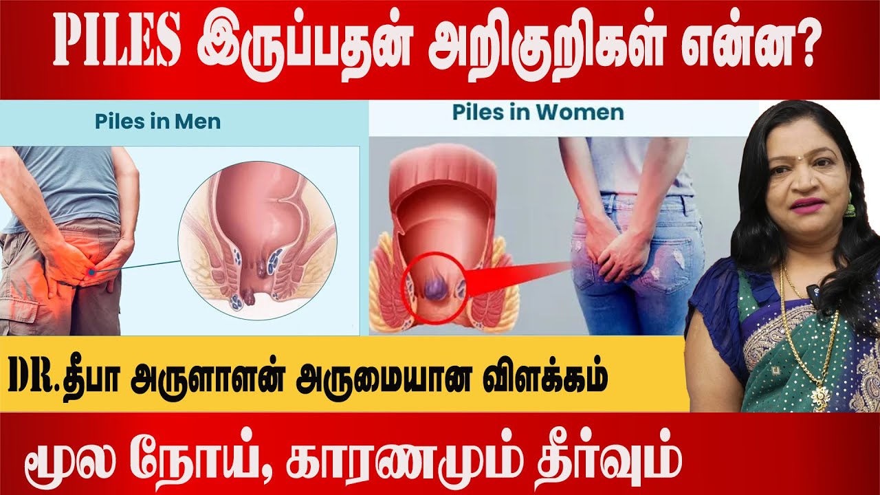 மூல நோய், காரணமும் தீர்வும் | piles symptoms | piles without surgery | Dr Deepa Arulaalan Tower News