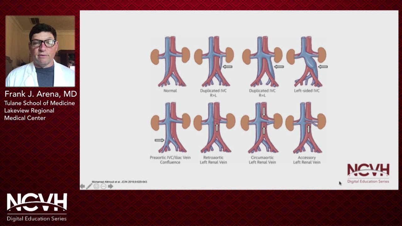 Dr. Frank Arena, How to Manage IVC Thrombosis