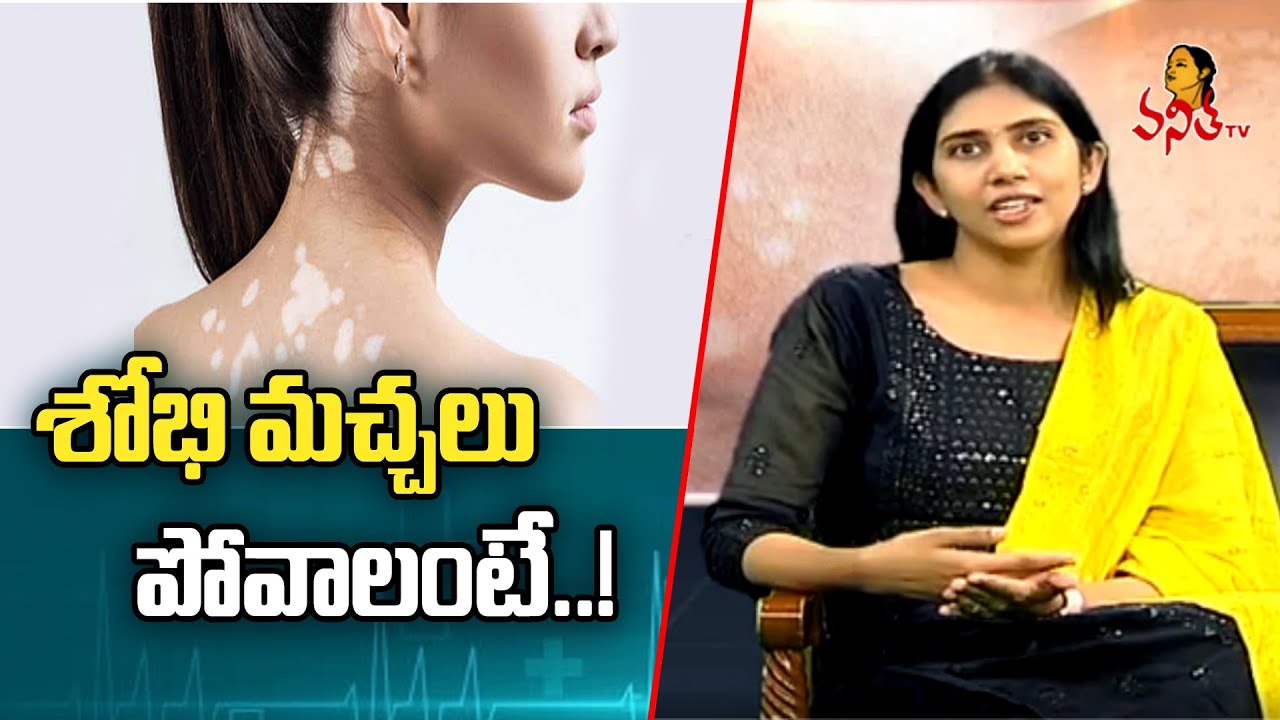 శోభి మచ్చలు పోవాలంటే..! | Treatment for Sobi Machalu | White Spots on Skin | Health Zone |Vanitha TV