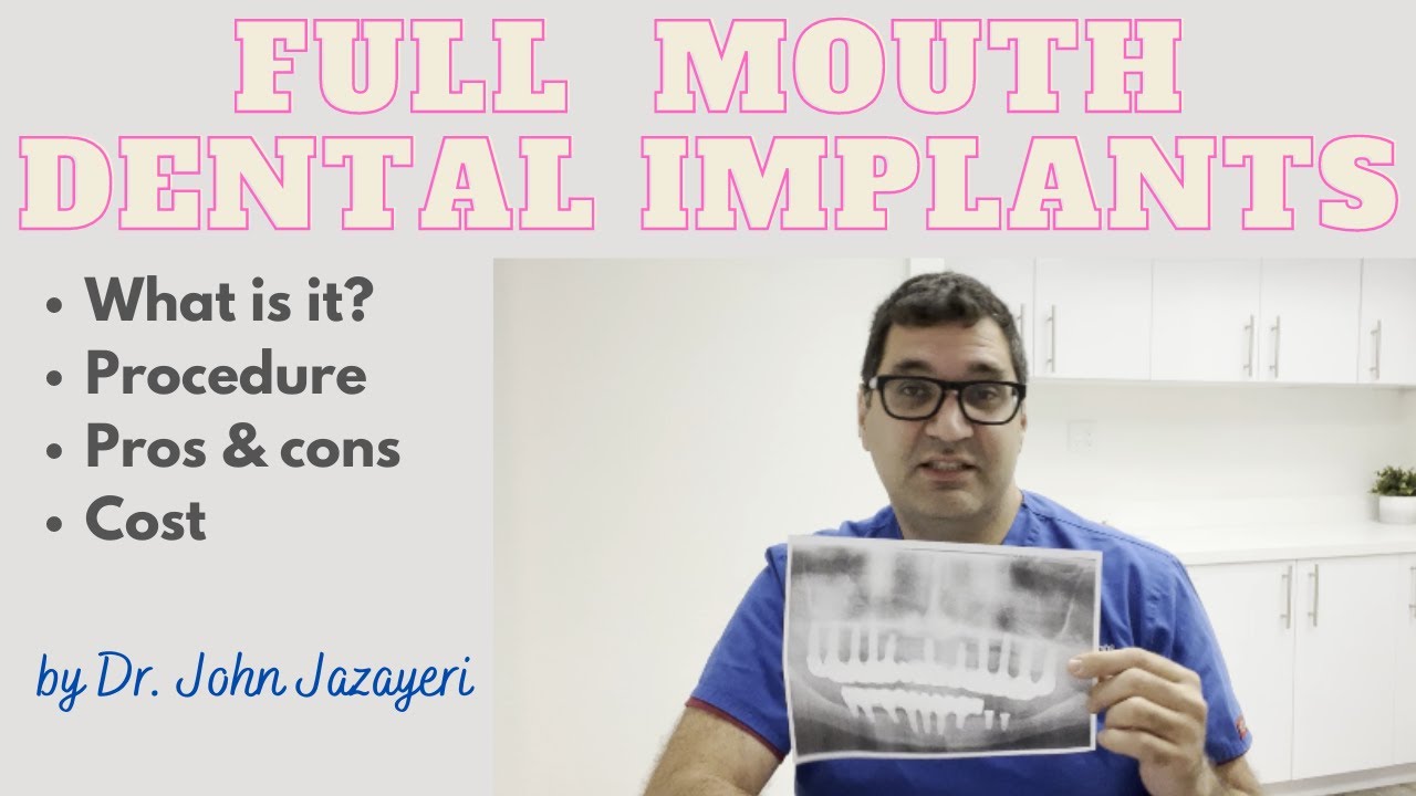 Full Mouth Dental Implants: When Only the Best Will Do!