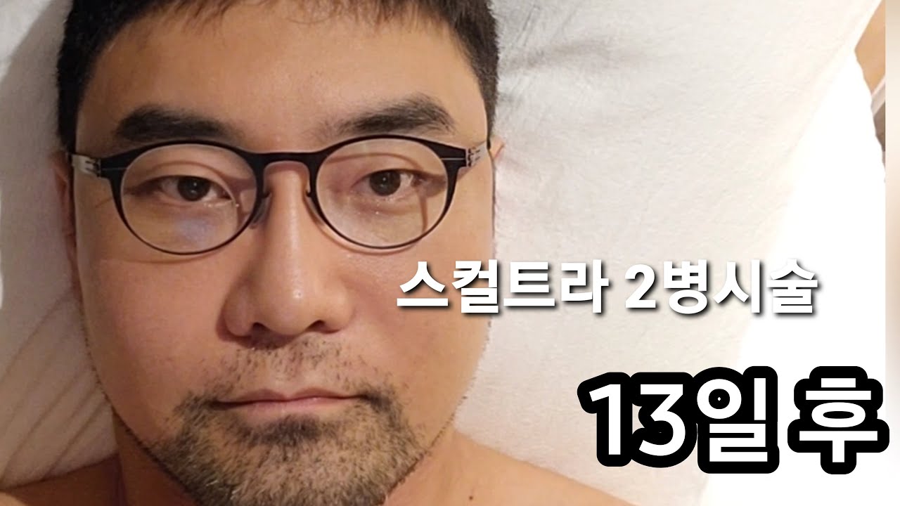 스컬트라 2바이알 51세 남자  얼굴 젊게 ㅎㅎ