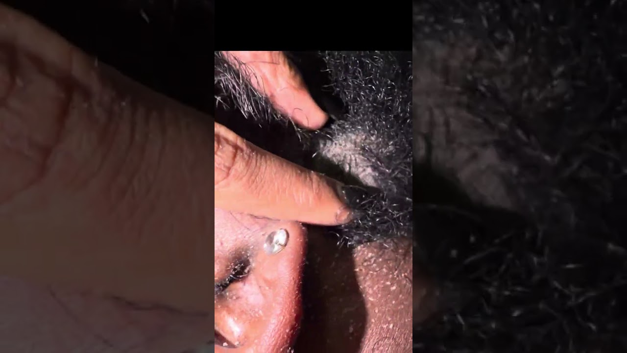 Beard Dandruff Scratching 