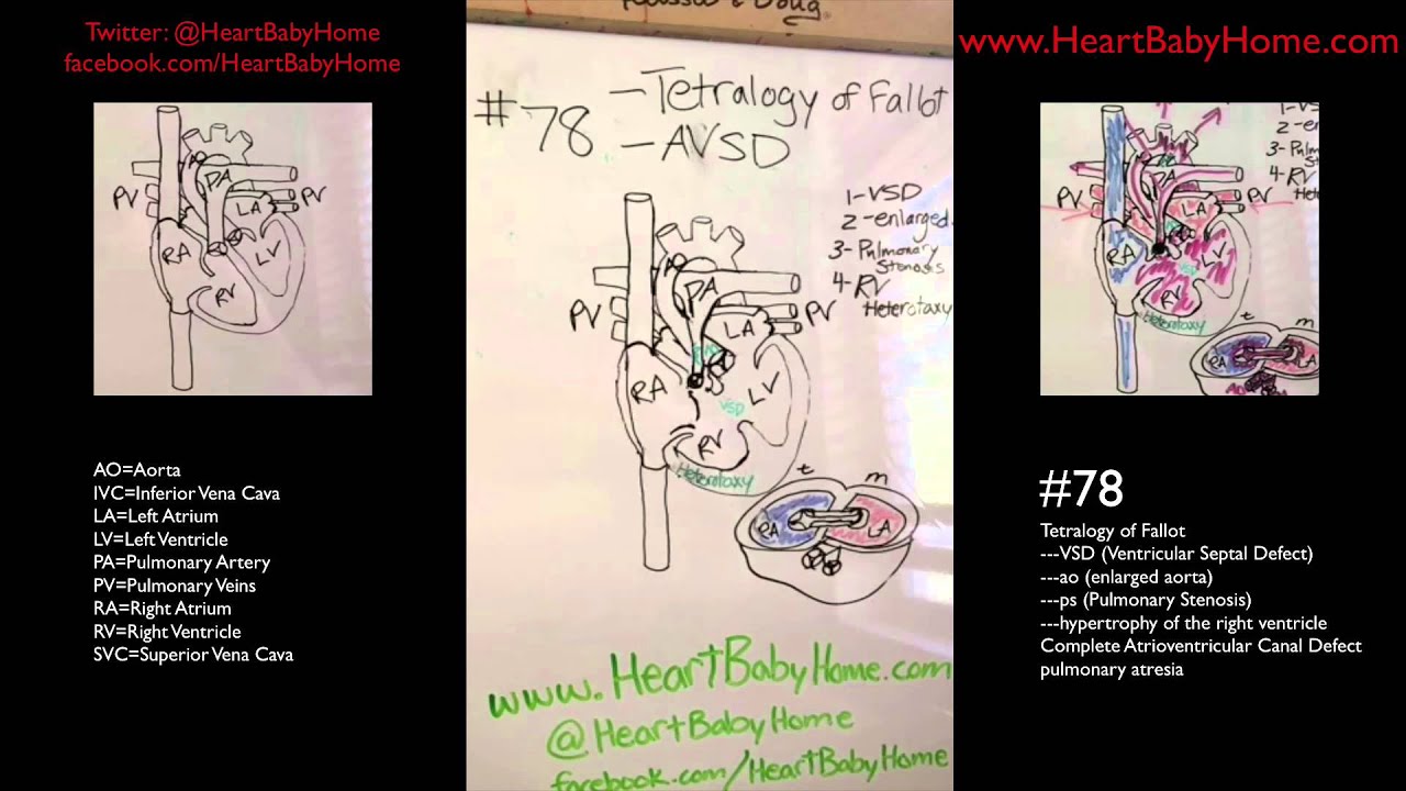 Heart Defect #78 - ToF, CAVC, pulmonary stenosis