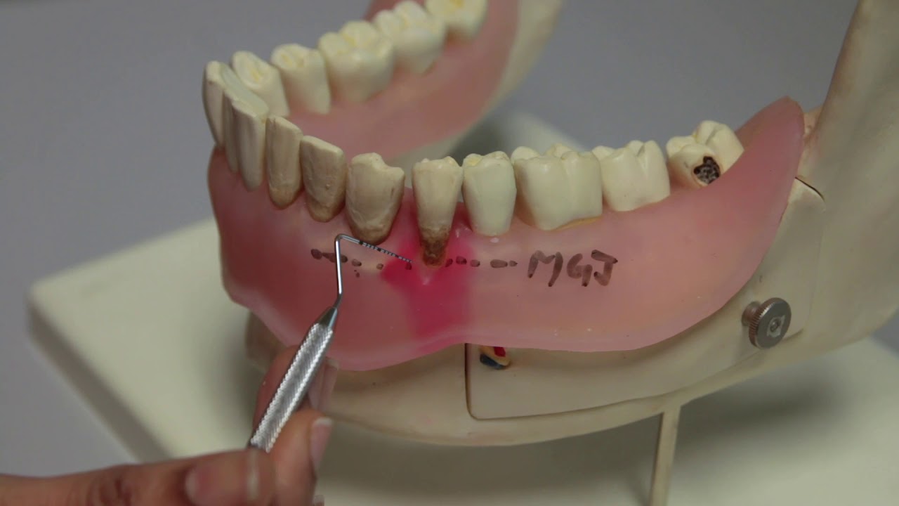 [Periodontal Examination Series]10.Gingival Recession (Miller Classification Gingival Recession1985)
