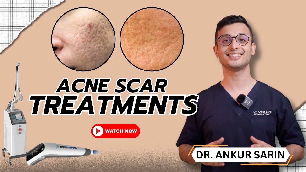 How I Treat Acne Scars | Dermatologist | Best devices Morpheus Dermapen 4 | l Dr Sarin |