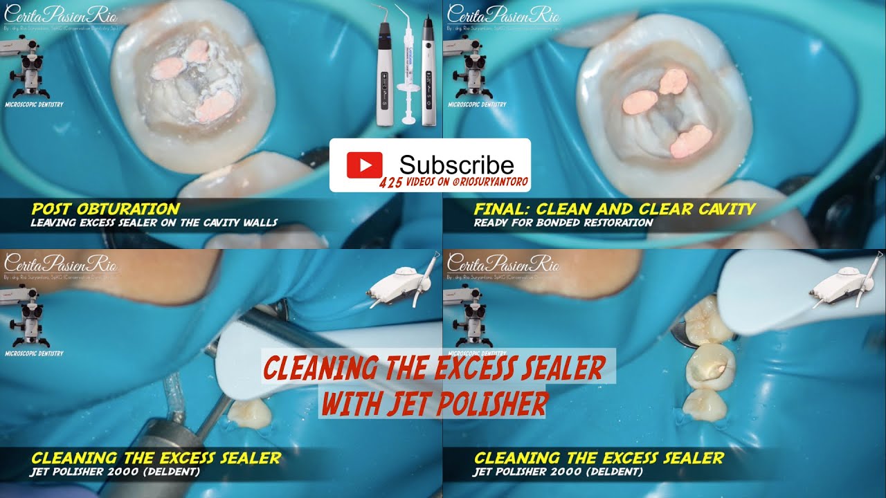 removal of excess endodontic sealer with jet polisher2000 deldent air abrasion in MOLAR dentistry