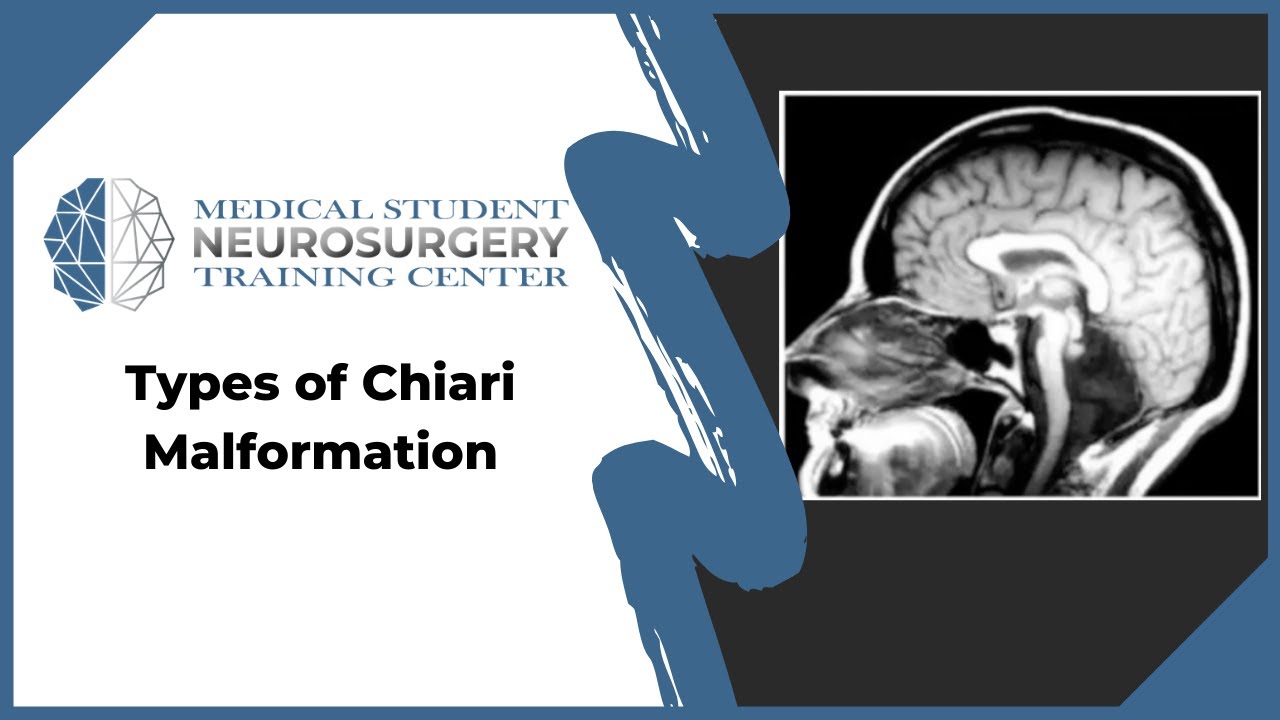 Types of Chiari Malformation