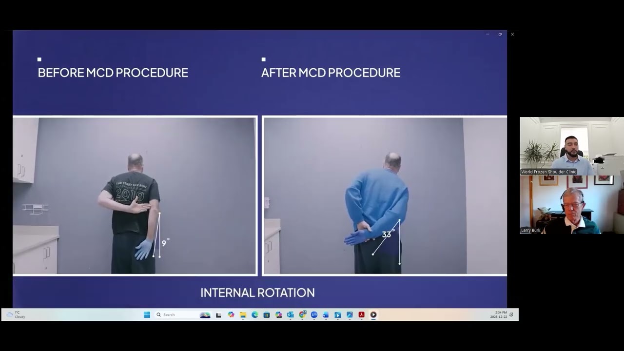 MCD Procedure from World Frozen Shoulder Clinic