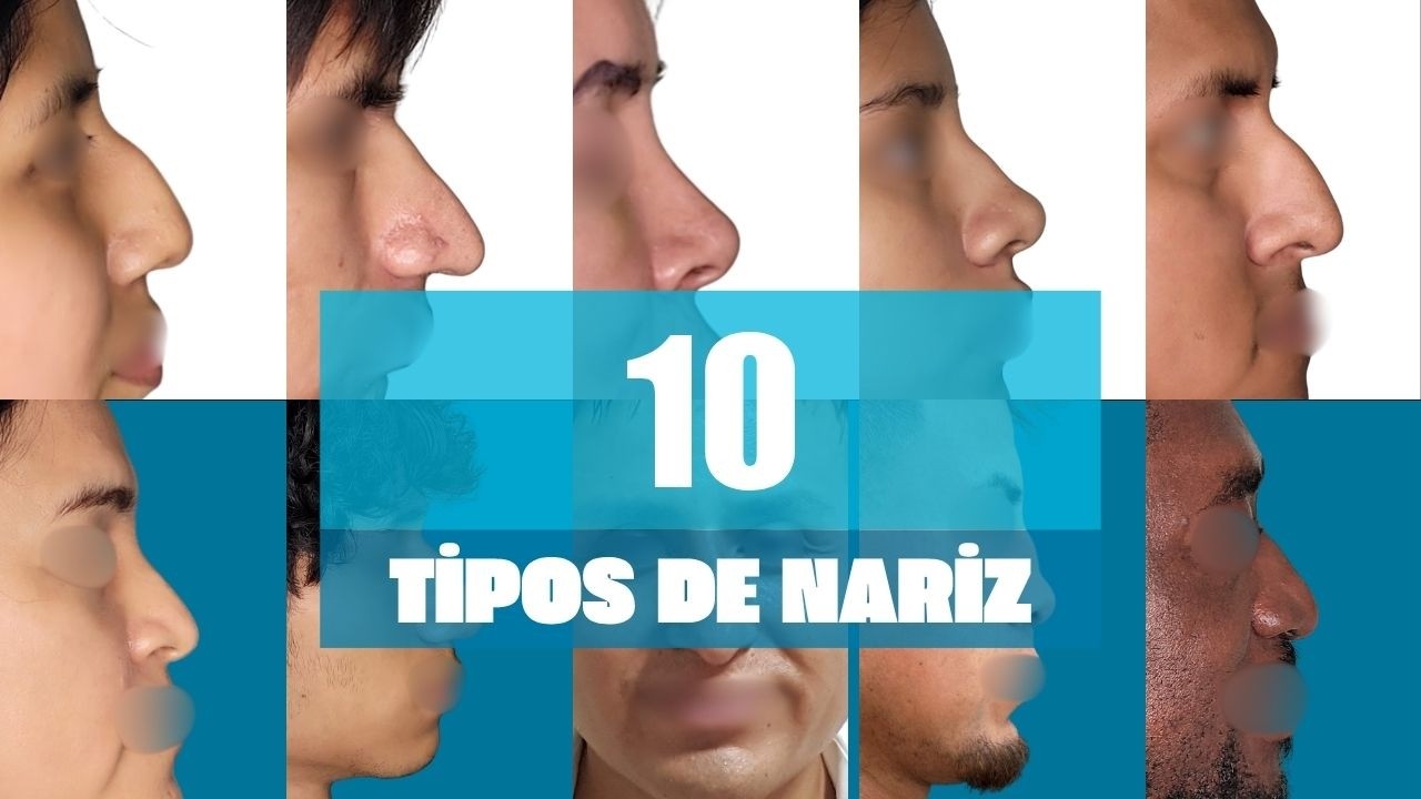 👉 Tipos de Nariz y Rinoplastia Femenina | Antes y Después con la Dra. Ronmy Méndez