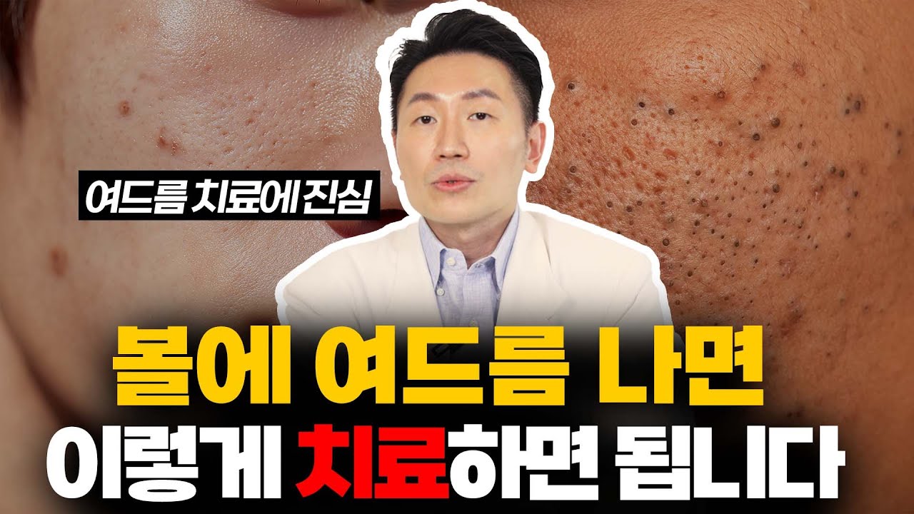 볼에 여드름이 났다? 이렇게만 치료하시면 돼요. 피부 안 좋았던 의사가 말해주는 여드름 관리법
