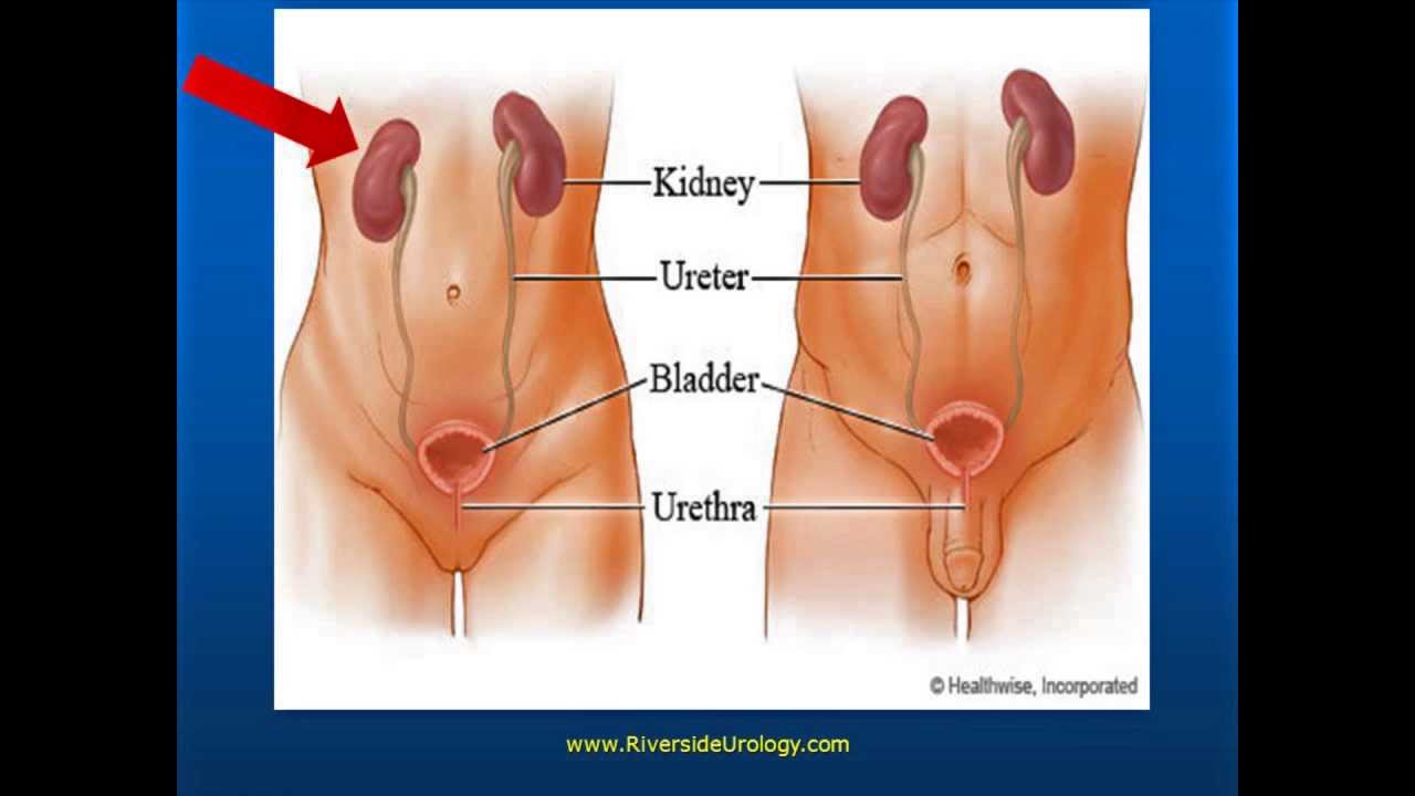 Kidney Stones Improved Solutions for a Big Pain stones502