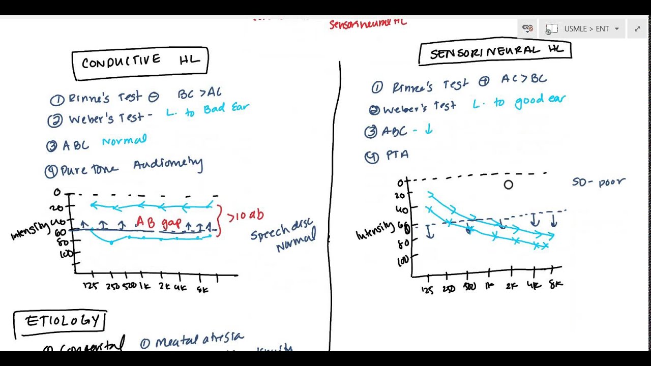 Conductive and Sensorineural Hearing Loss Deafness for USMLE