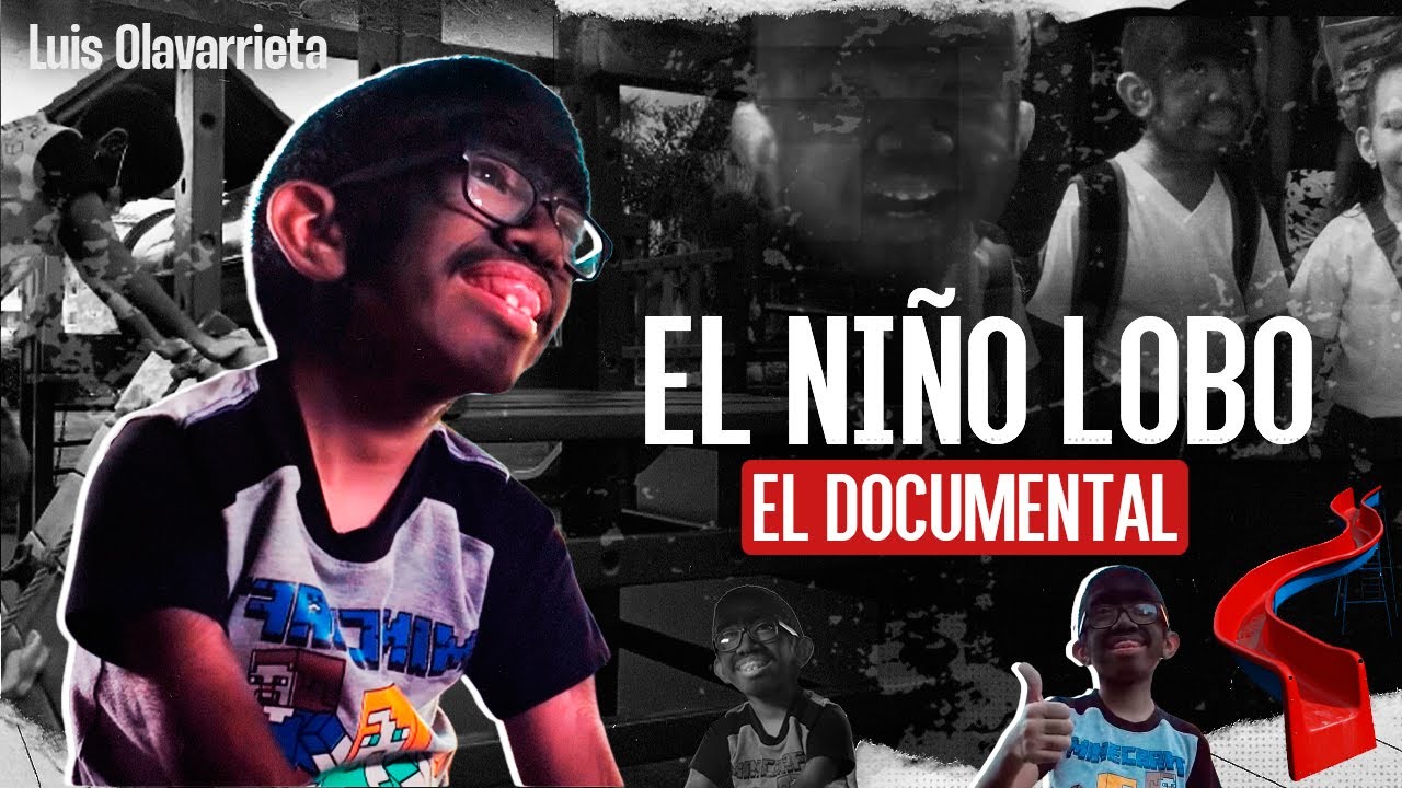 El caso de EL NI&Ntilde;O LOBO, el &uacute;nico registrado en #Venezuela