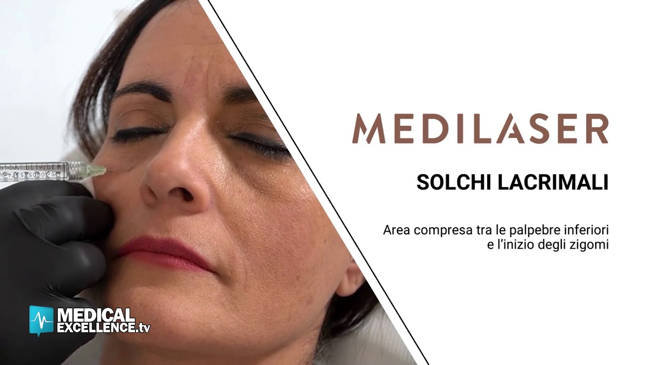 Occhiaie e solchi lacrimali, trattamento di ringiovanimento del viso