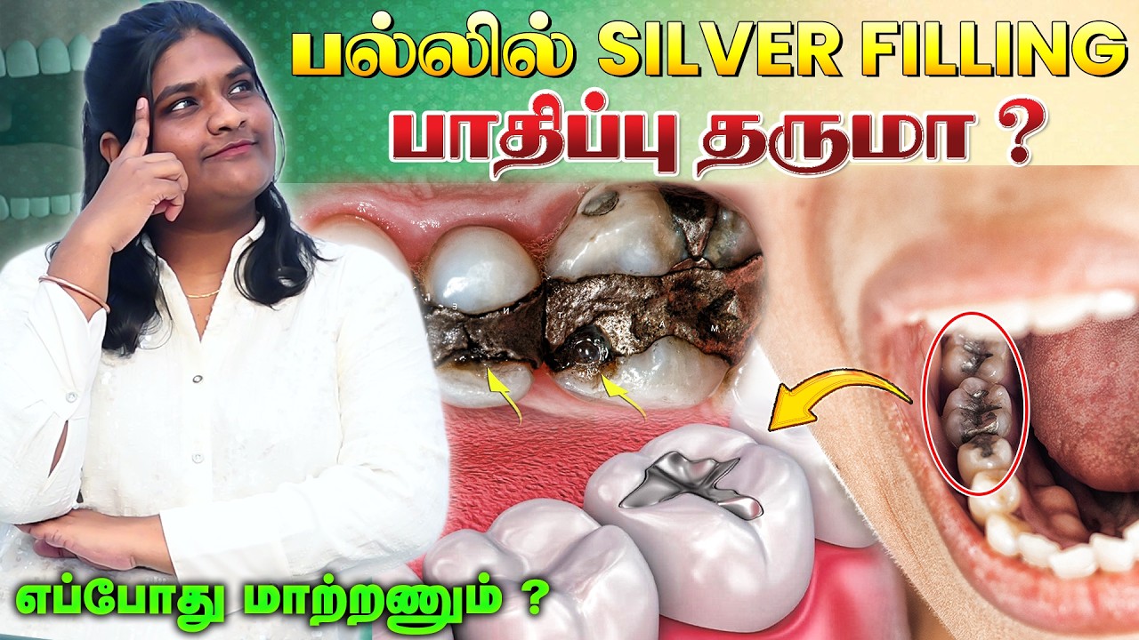 பல்லில் Silver Filling பாதிப்பு தருமா ? எப்போது மாற்றணும் ?  Dentist Explains | Universe Dental Care