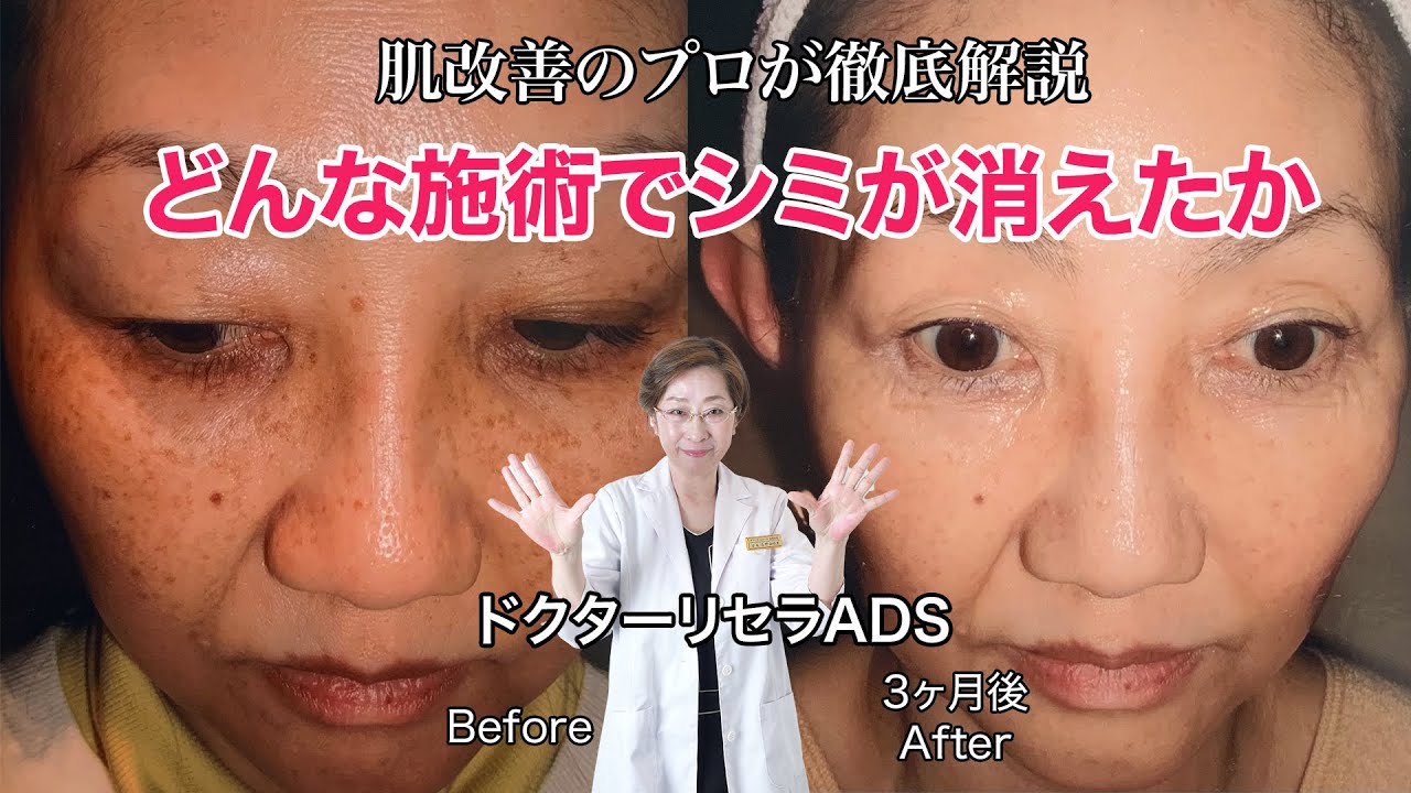ドクターリセラADS「真実の声」
