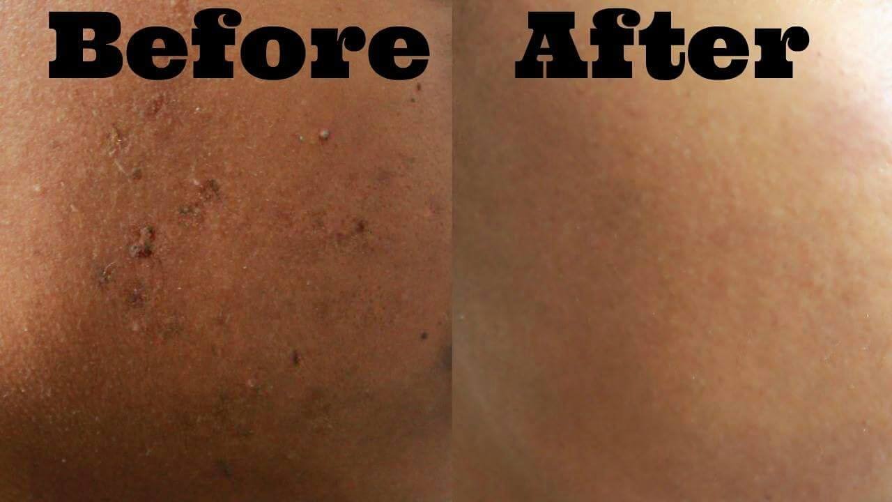 EASY Skincare Routine | Remove Dark Marks and Scars FAST!
