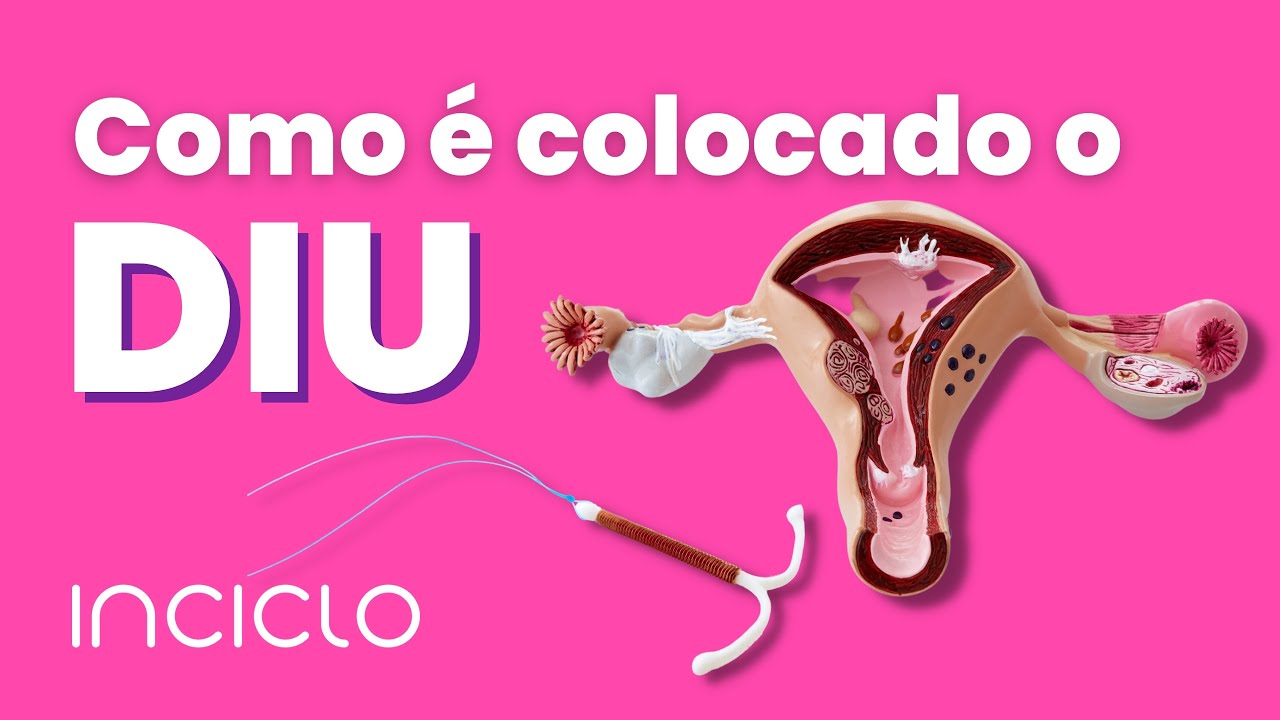 Como &eacute; Colocado o Diu - Como Funciona a Coloca&ccedil;&atilde;o do Diu