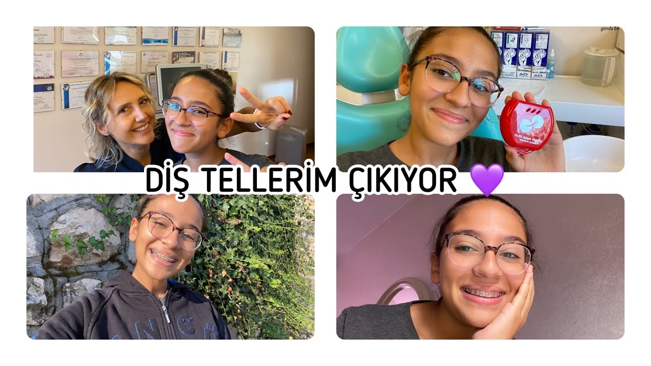 Diş Tellerim Çıkıyor !! | Ortodontik Tedavimin Sonu 🥺 ilginç Sabah Rutinim  | İdil Duru Çınar