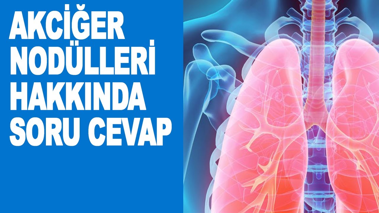 AKCİĞER NODÜLLERİ HAKKINDA SORU-CEVAP #1