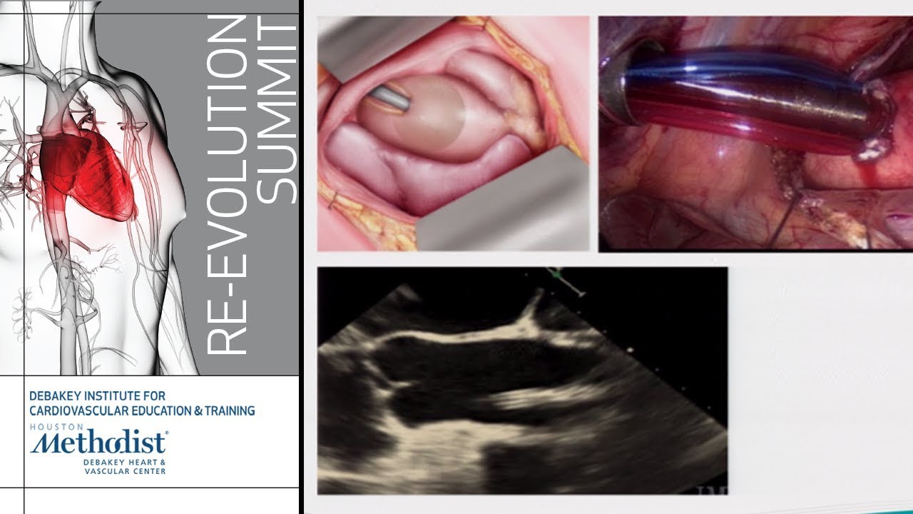 Perfusion and Cannulation in MICS (Eric Skipper, MD)