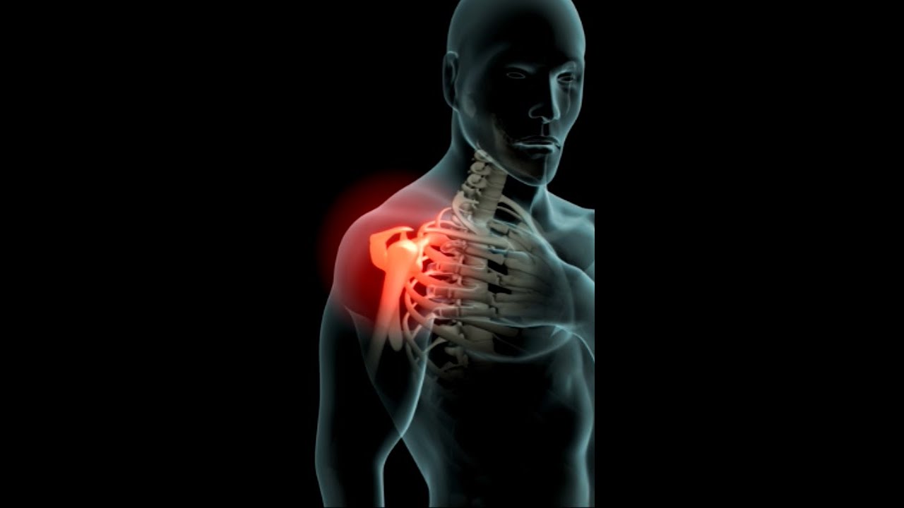 Shoulder pain (rotator cuff tear) and surgical repair #science #anatomy #shorts