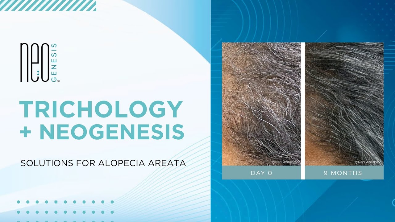 Trichology + NeoGenesis | Solutions for Alopecia Areata