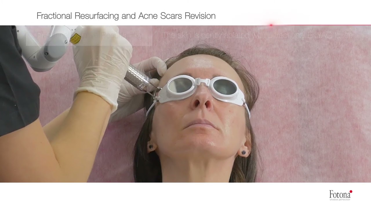 Fotona Laser Skin Resurfacing