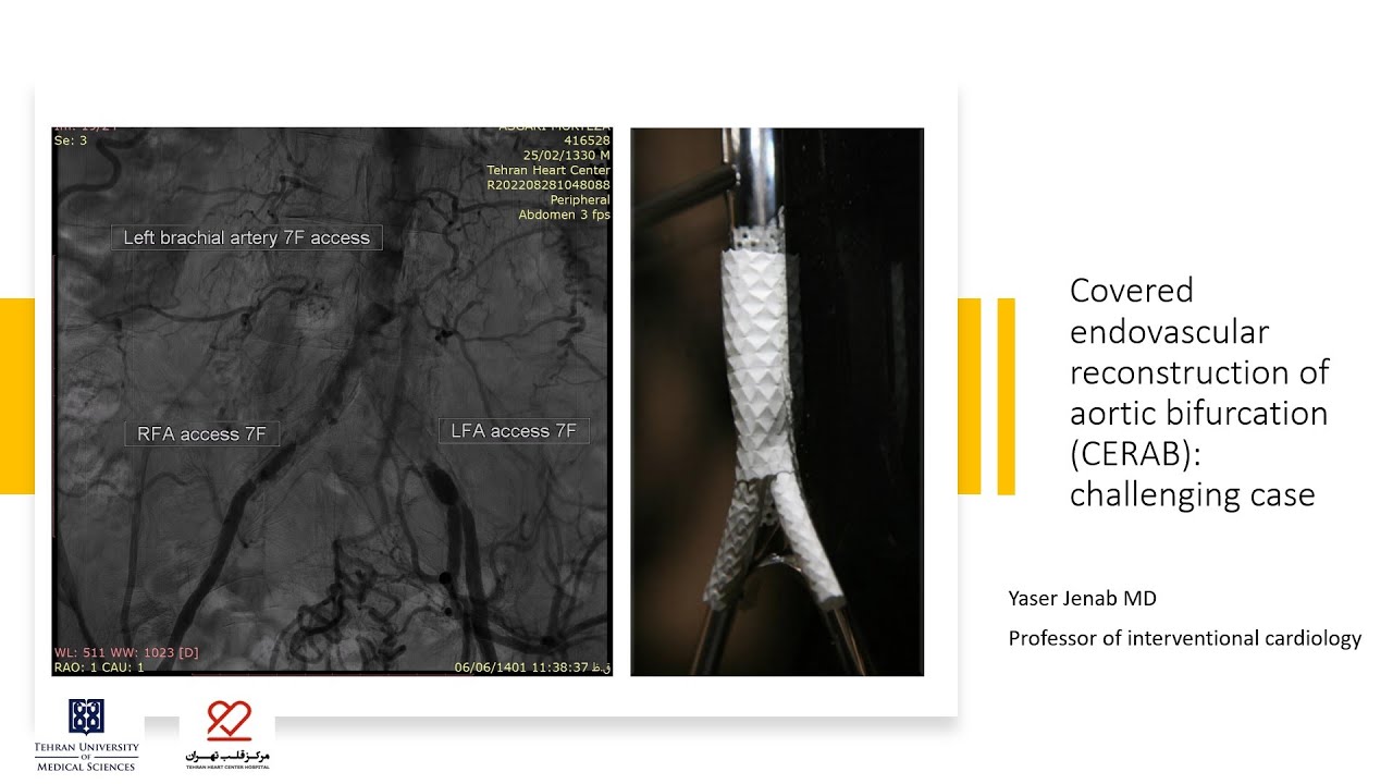 Covered endovascular reconstruction of aortic bifurcation (CERAB): challenging case